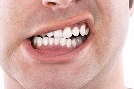 Bạn có biết 7 thói quen hằng ngày đang hủy hoại hàm răng