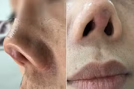 Thẩm mỹ giá rẻ, cô gái đau khổ khi mũi hếch lên xấu xí