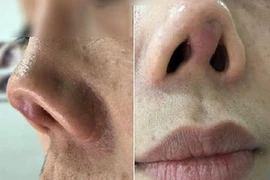 Thẩm mỹ giá rẻ, cô gái đau khổ khi mũi hếch lên xấu xí