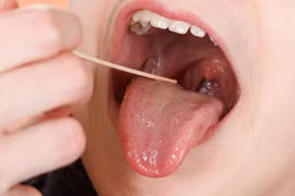 Soi những triệu chứng ung thư lưỡi