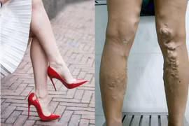 Nguyên nhân làm giãn tĩnh mạch này bạn đã biết chưa