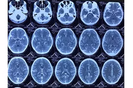 Đau đầu thiếu nữ bất ngờ phát hiện dị dạng mạch não