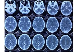 Đau đầu thiếu nữ bất ngờ phát hiện dị dạng mạch não