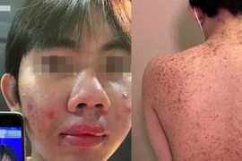 Mua silicon ở chợ về tiêm, cả xóm biến chứng nặng một người tử vong