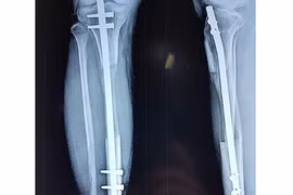 Ca phẫu thuật kéo dài chân kỷ lục ở Việt Nam