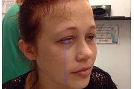 Đua đòi xăm tròng mắt, cô gái trẻ bị chảy dịch tím, có nguy cơ mù