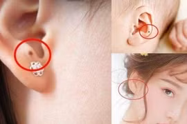 Nốt ruồi ở tai nói lên điều gì về tương lai của bạn?