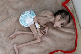 Xót xa hình ảnh cậu bé 7 tuổi bị liệt nặng vỏn vẹn 7kg