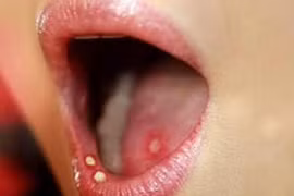 3 dấu hiệu vùng đầu cổ phải nghĩ ngay đến ung thư lưỡi