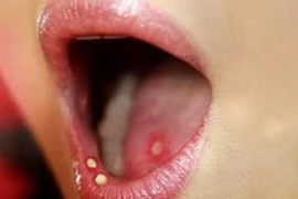 3 dấu hiệu vùng đầu cổ phải nghĩ ngay đến ung thư lưỡi