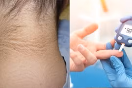 Người có đường huyết cao thường thấy 5 biểu hiện này 