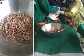 Tưởng bị táo bón, bác sĩ gắp ra từ ruột bé trai 4 tuổi cả chậu giun