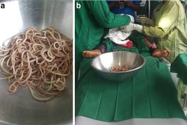 Tưởng bị táo bón, bác sĩ gắp ra từ ruột bé trai 4 tuổi cả chậu giun