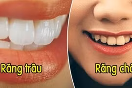 Nhìn tướng răng biết tương lai bạn thành tỷ phú hay nghèo nàn 