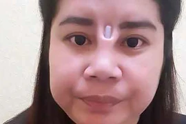 Rùng rợn với những ca nâng mũi hỏng, lòi sụn giả