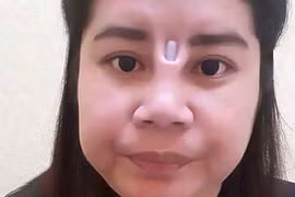 Rùng rợn với những ca nâng mũi hỏng, lòi sụn giả