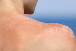 Khi bị cháy nắng mà làm điều này sẽ tự rước họa vào thân