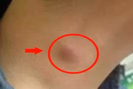 1 chậm, 2 lồi, 3 nhiều xuất hiện trên cơ thể cảnh báo phổi rất yếu