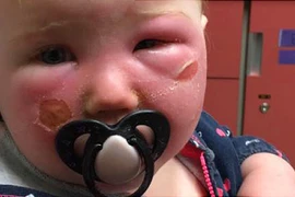 Bị bỏng vì kem chống nắng: Những điều cha mẹ cần biết