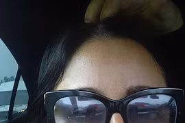 Chi 1.500 bảng để có má lúm đồng tiền