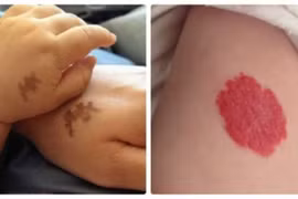 Người sở hữu vết bớt ở 4 vị trí này cả đời giàu sang phú quý