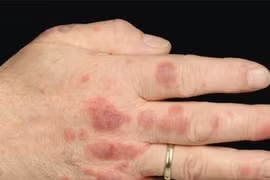 Nhờ vết mẩn đỏ trên tay người đàn ông phát hiện mình mắc bệnh hiểm nghèo