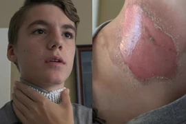 Cậu bé bị bạn thân tạt nước sôi, đốt bằng bật lửa khi đang ngủ