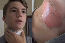 Cậu bé bị bạn thân tạt nước sôi, đốt bằng bật lửa khi đang ngủ