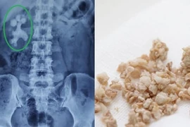 Những sai lầm trong ăn uống khiến nguy cơ mắc sỏi thận tăng cao