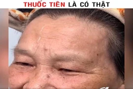 'Thần dược' xóa nhăn 'giả trân' đến nỗi mất luôn cả lông mày
