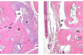 Canada phát triển phương pháp mới điều trị các bệnh tự miễn