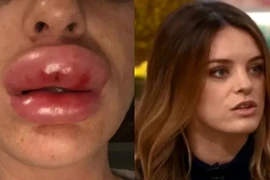 Tiêm botox tại nhà, gái xinh nhận "trái đắng"
