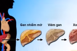 2 thói quen khi thức dậy buổi sáng hại gan hơn uống bia rượu