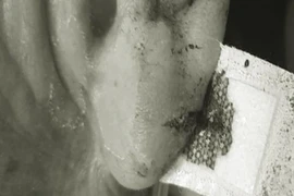 Cứa tai, chích máu tay chữa đột quỵ ?