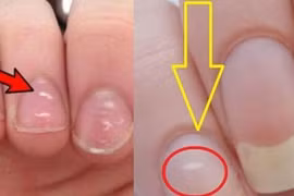 5 bộ phận này chuyển sang màu trắng tiết lộ cơ thể bạn có vấn đề