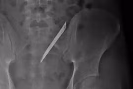 Lấy lưỡi dao 12 cm nằm 4 năm ở lưng nam thanh niên