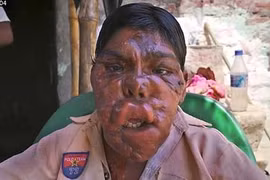 Cậu bé “mặt quỷ” và niềm vui lần đầu được đến trường