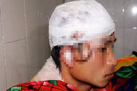 Nghệ An: Giả chết vẫn bị gấu rừng tát rách đầu