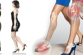 Chị em đi giày cao gót để đẹp nhưng khiến bộ phận này đau đớn