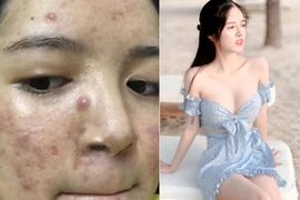Cô gái mặt chi chít mụn lột xác 180 độ, xinh đẹp như thiên thần