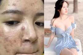 Cô gái mặt chi chít mụn lột xác 180 độ, xinh đẹp như thiên thần