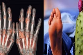 Căn bệnh "nhà giàu" gây đau đớn, mất ăn mất ngủ