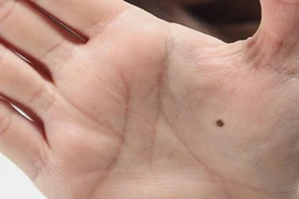 Có 1 nốt ruồi này năm 2022 tài lộc ùa đến chật ví