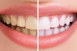 3 công thức tẩy trắng răng tại nhà vô cùng đơn giản 