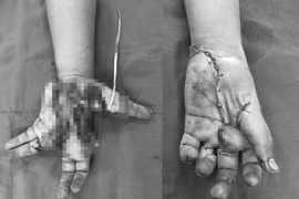 Nam thiếu niên 14 tuổi ở Hải Dương nát tay trái do nổ điện thoại