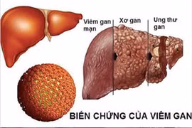 7 loại viêm nhiễm không nên coi thường vì dễ dẫn đến ung thư