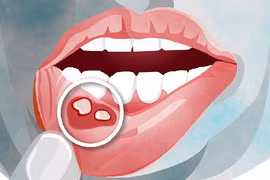 Vì sao bệnh ung thư miệng ngày càng nhiều, chủ yếu là phụ nữ? 