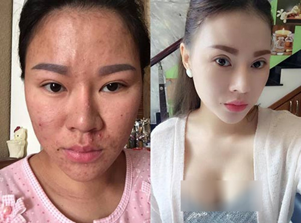 Gần đây, bà mẹ 9x Nguyễn Anh Loan đã chia về hành trình "lột xác" của mình với mong muốn nhiều chị em phụ nữ sẽ có thêm kinh nghiệm và quyết tâm để làm đẹp sau sinh. Dưới đây là quá trình phẫu thuật thẩm mỹ đau đớn của bà mẹ 9x Hà Thành này.