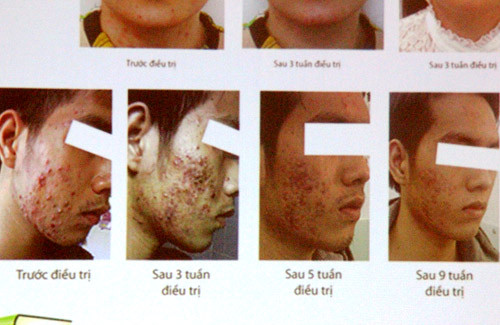 Gương mặt của anh Tuấn khi chưa điều trị cho thấy sự tàn phá của corticoid đối với làn da. Trong buổi tọa đàm, nhiều câu hỏi của phóng viên và khách tham dự về tác hại của corticoid đối với sức khoẻ, sắc đẹp phụ nữ đã được BS Cẩm Anh trả lời và tư vấn một cách thiết thực, chi tiết.