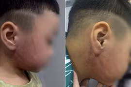 Công an xác minh vụ bé 4 tuổi nghi bị giáo viên mầm non đánh bầm tím mặt